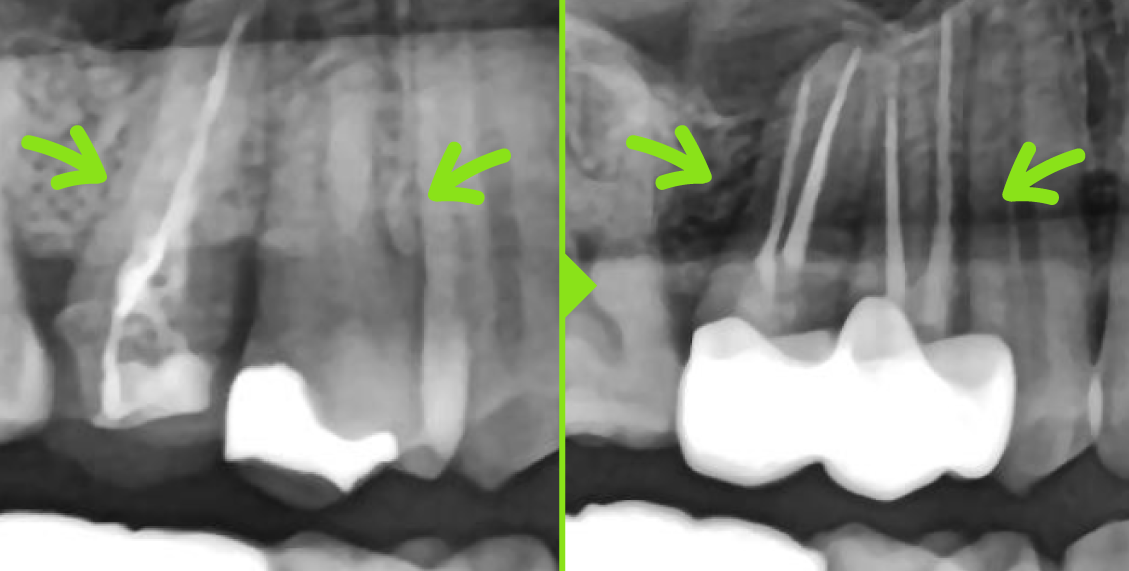 신경치료 / 재신경치료 / 치근단 절제술 케이스